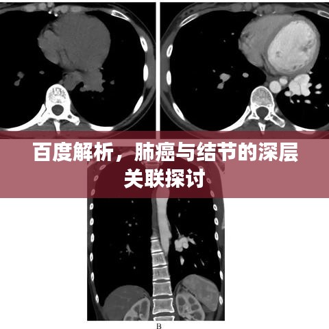 百度解析，肺癌与结节的深层关联探讨